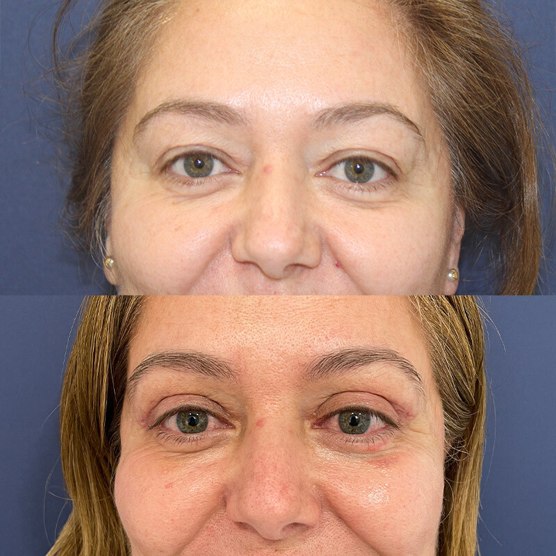 Images Clínica Pérez Espadero | Blefaroplastia y Mastopexia en Valencia