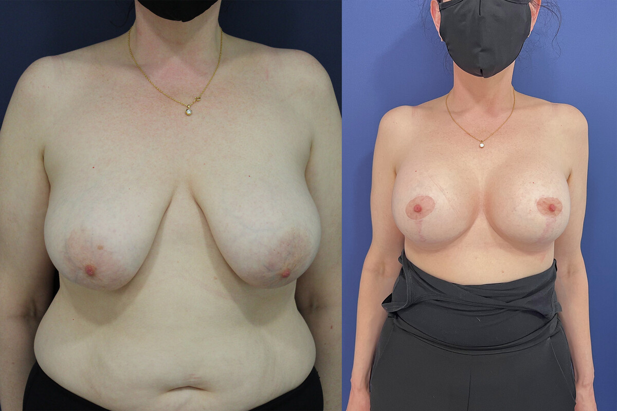 Images Clínica Pérez Espadero | Blefaroplastia y Mastopexia en Valencia