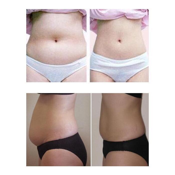Images Ice Lipo in Plymouth, Put The Diet On Ice.