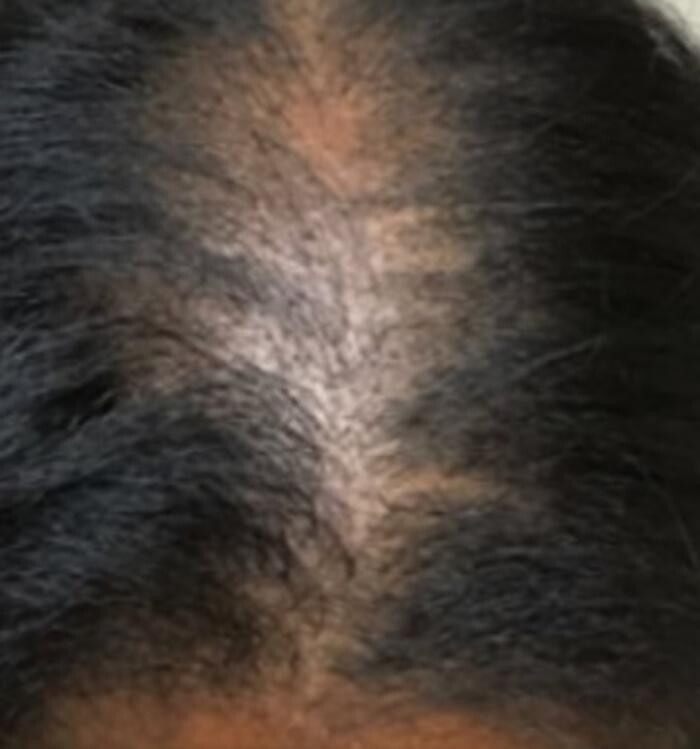 Images Trichosynergy Hair & Scalp Micropigmentation Clinic