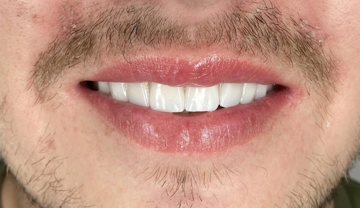 Images Dentist Algodones Mexico | Implants Crowns Zirconia | We accept Insurance Dental Ulloa