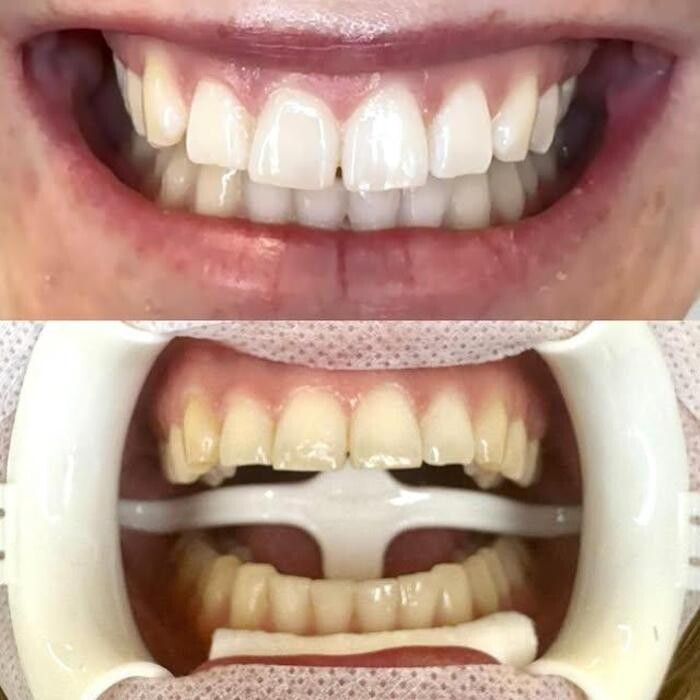 Images Teeth Whitening Christchurch | Golden Grin