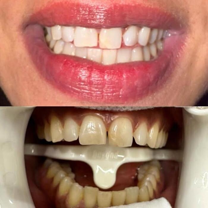 Images Teeth Whitening Christchurch | Golden Grin