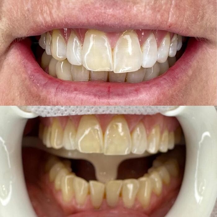 Images Teeth Whitening Christchurch | Golden Grin