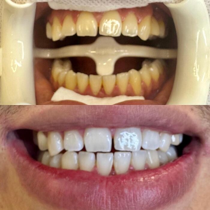 Images Teeth Whitening Christchurch | Golden Grin