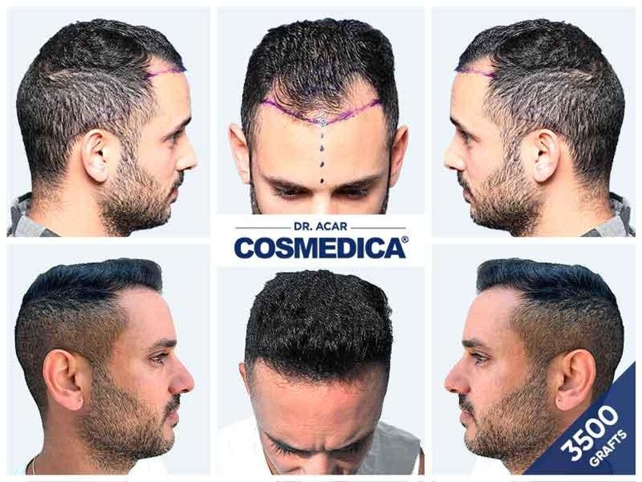 Images Cosmedica Hair Transplant Clinic - Turkey Istanbul