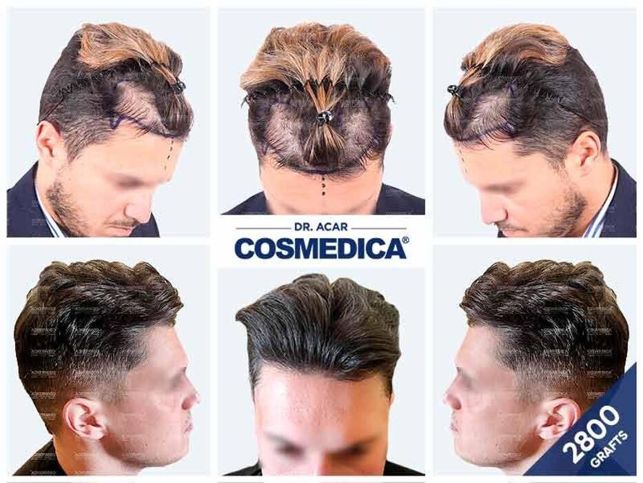 Images Cosmedica Hair Transplant Clinic - Turkey Istanbul