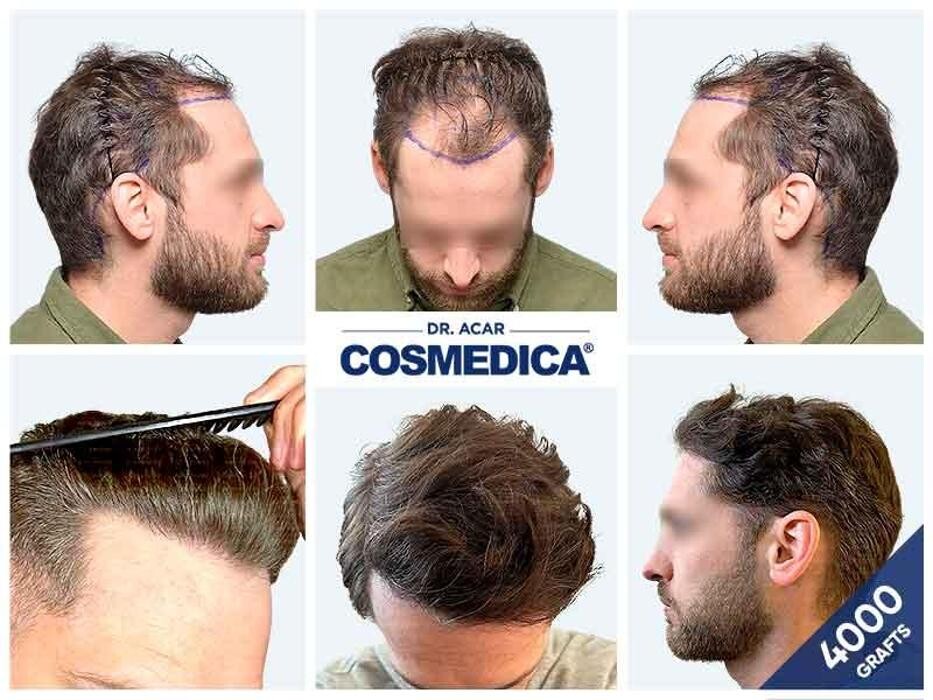 Images Cosmedica Hair Transplant Clinic - Turkey Istanbul