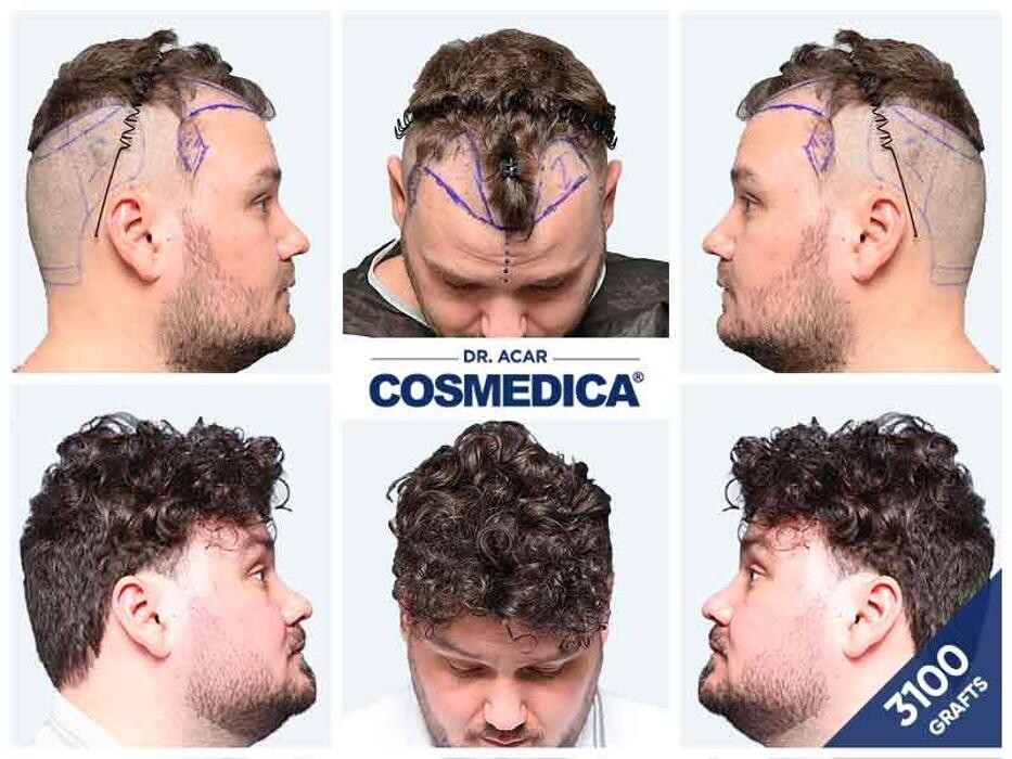 Images Cosmedica Hair Transplant Clinic - Turkey Istanbul