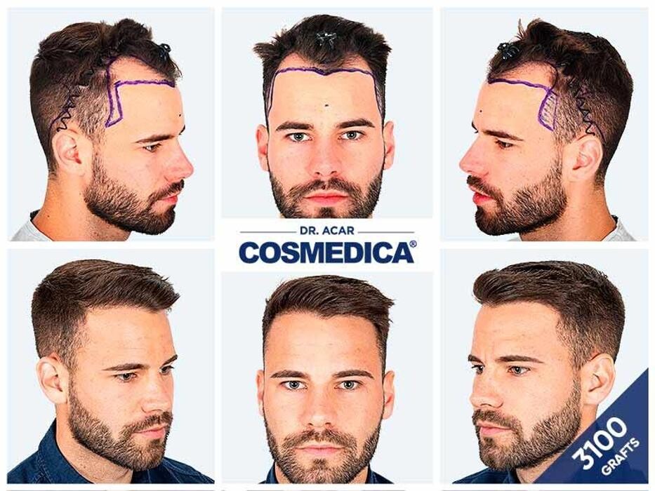 Images Cosmedica Hair Transplant Clinic - Turkey Istanbul