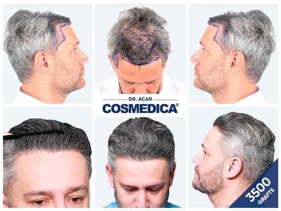 Images Cosmedica Hair Transplant Clinic - Turkey Istanbul