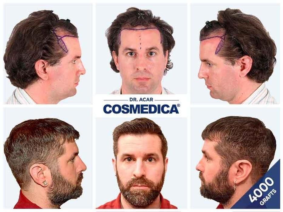 Images Cosmedica Hair Transplant Clinic - Turkey Istanbul