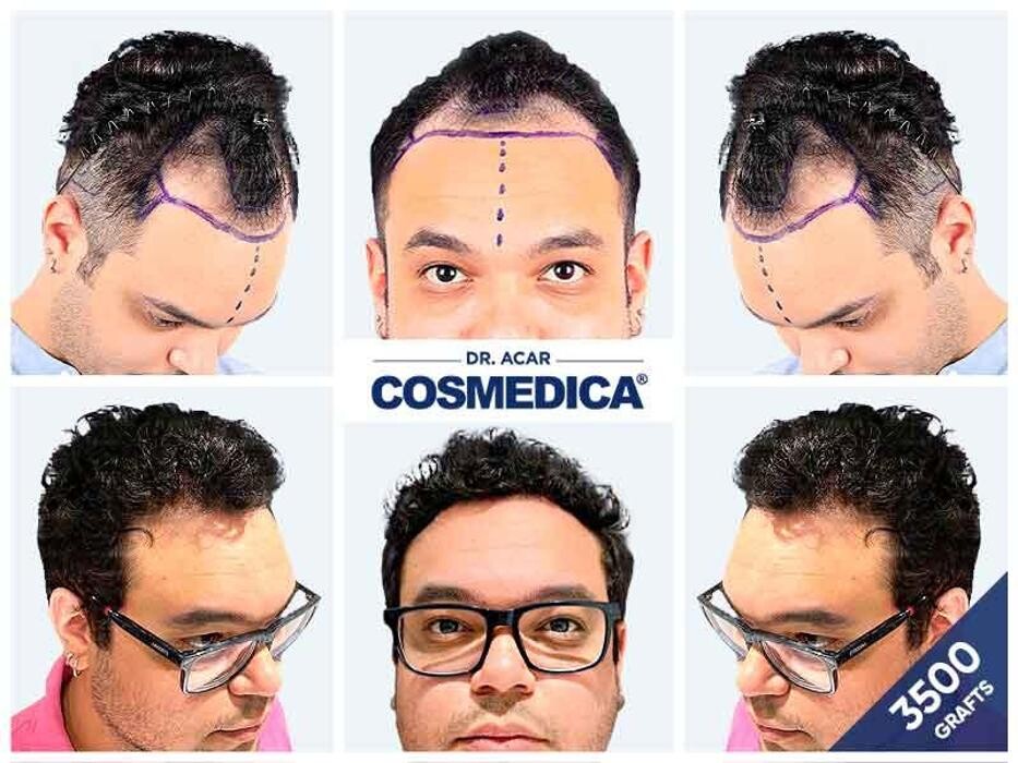 Images Cosmedica Hair Transplant Clinic - Turkey Istanbul