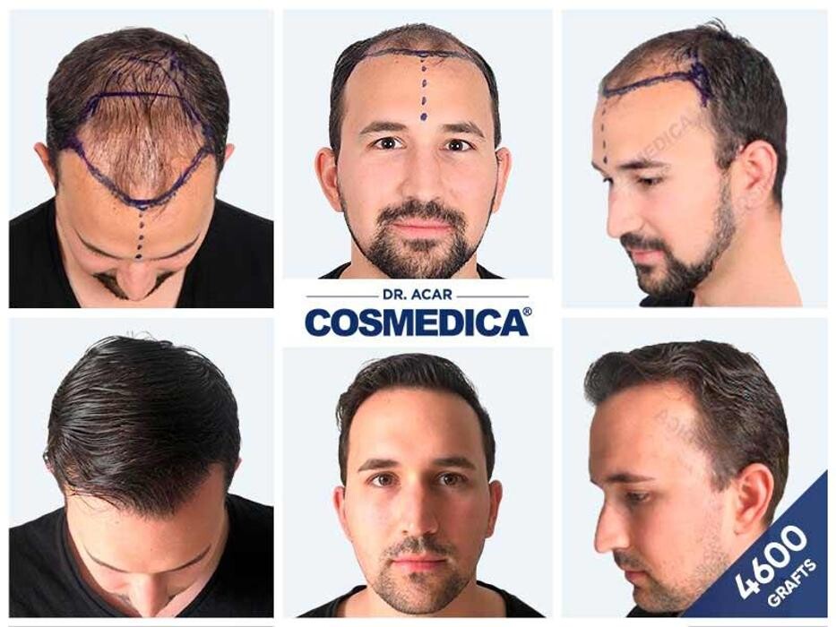 Images Cosmedica Hair Transplant Clinic - Turkey Istanbul