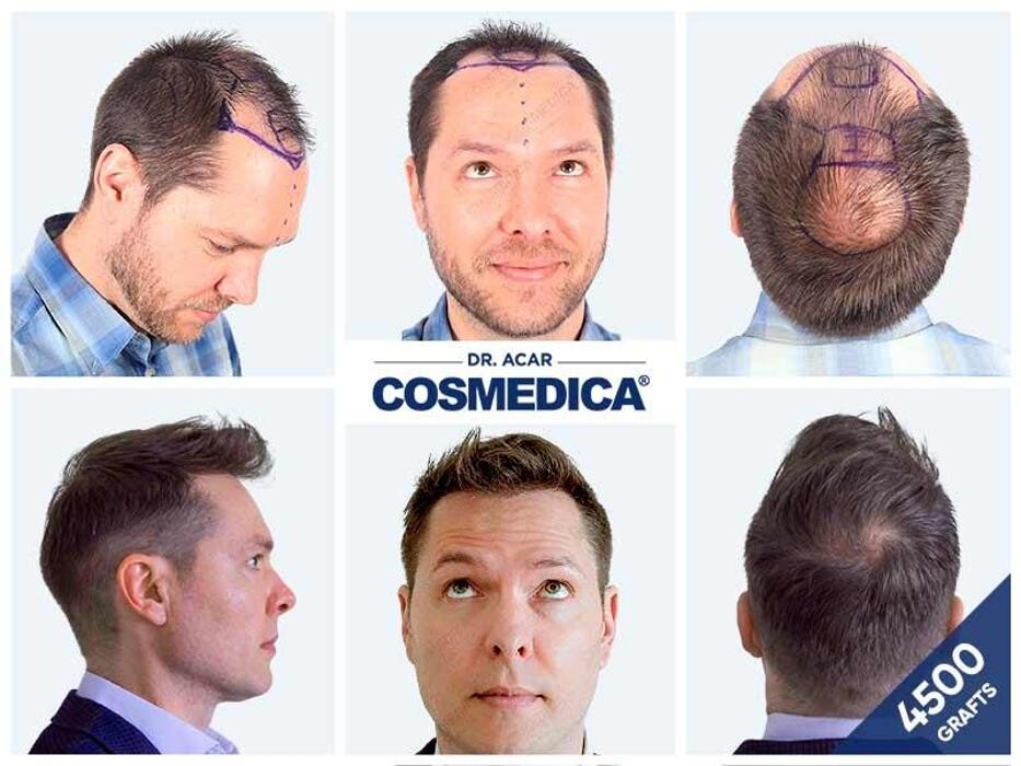 Images Cosmedica Hair Transplant Clinic - Turkey Istanbul