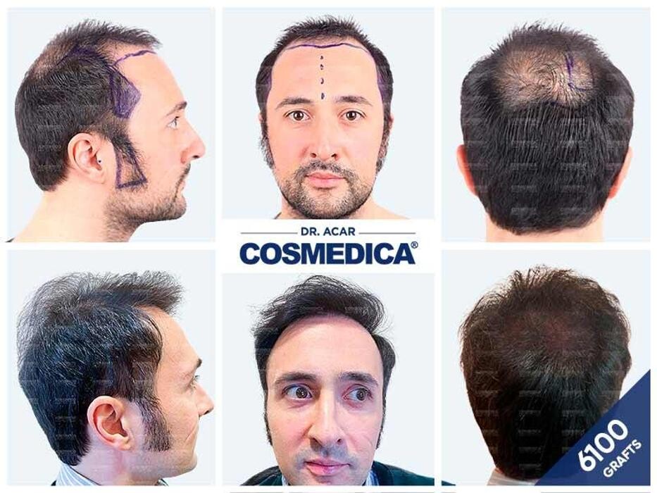 Images Cosmedica Hair Transplant Clinic - Turkey Istanbul