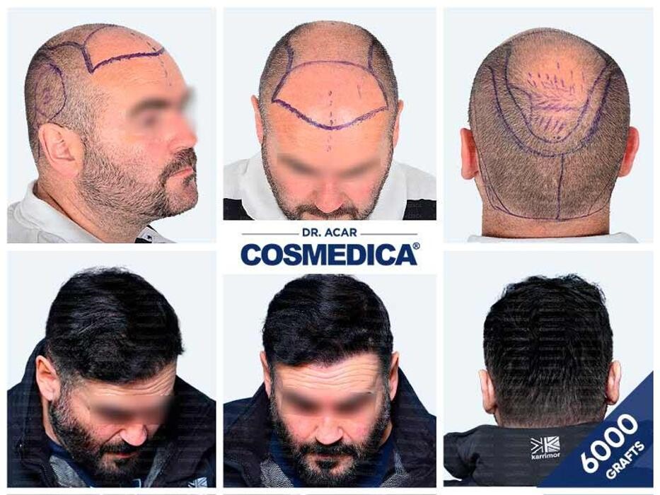 Images Cosmedica Hair Transplant Clinic - Turkey Istanbul