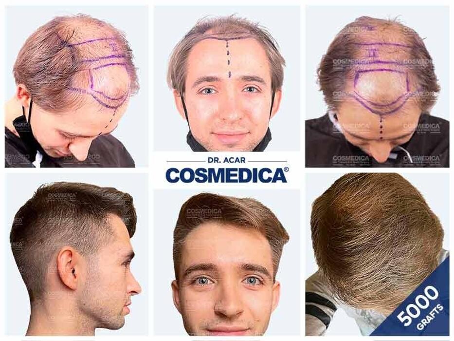 Images Cosmedica Hair Transplant Clinic - Turkey Istanbul