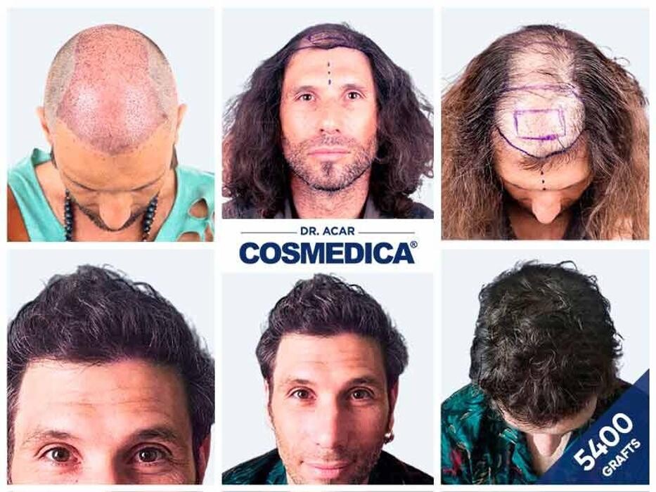 Images Cosmedica Hair Transplant Clinic - Turkey Istanbul