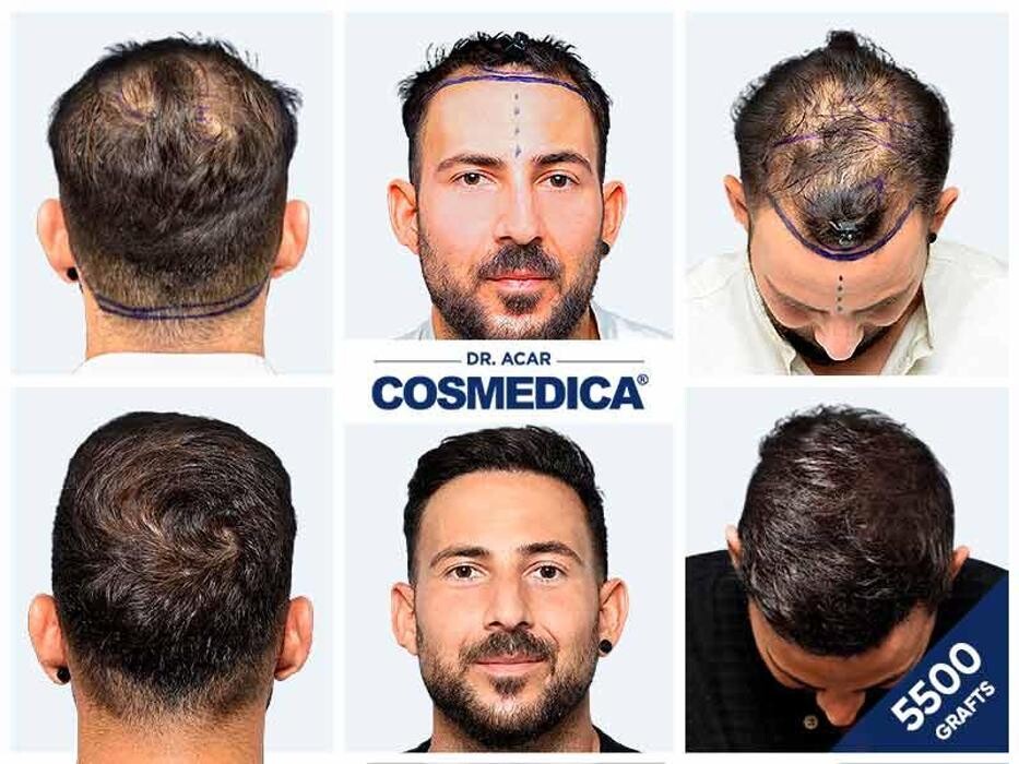 Images Cosmedica Hair Transplant Clinic - Turkey Istanbul