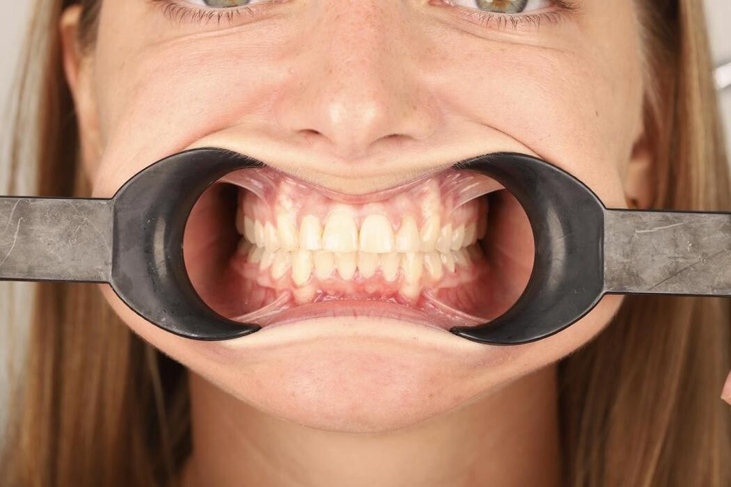 Images Ortodonti Uzmanı Çağrı Şibal - Ortodontik Tedavi I İzmir Şeffaf Plak I invisalign