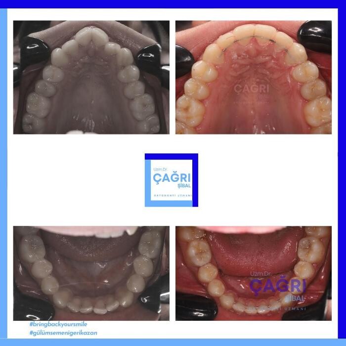 Images Ortodonti Uzmanı Çağrı Şibal - Ortodontik Tedavi I İzmir Şeffaf Plak I invisalign