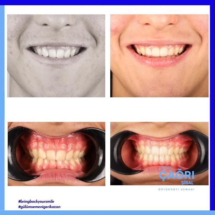 Images Ortodonti Uzmanı Çağrı Şibal - Ortodontik Tedavi I İzmir Şeffaf Plak I invisalign