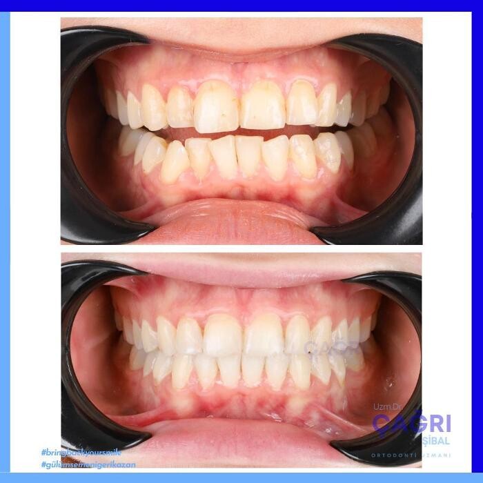 Images Ortodonti Uzmanı Çağrı Şibal - Ortodontik Tedavi I İzmir Şeffaf Plak I invisalign