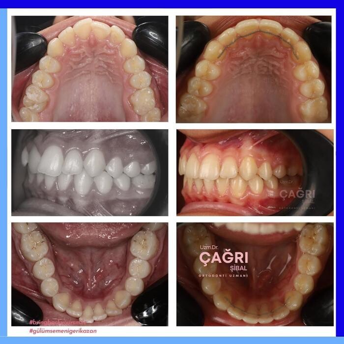 Images Ortodonti Uzmanı Çağrı Şibal - Ortodontik Tedavi I İzmir Şeffaf Plak I invisalign