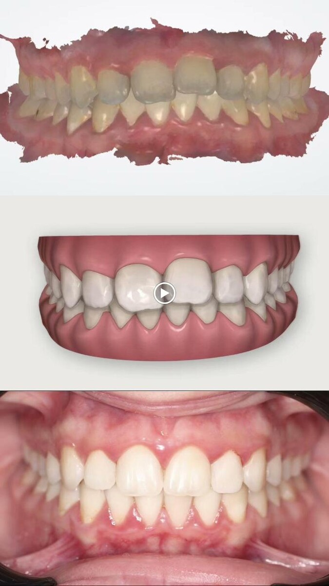 Images Ortodonti Uzmanı Çağrı Şibal - Ortodontik Tedavi I İzmir Şeffaf Plak I invisalign