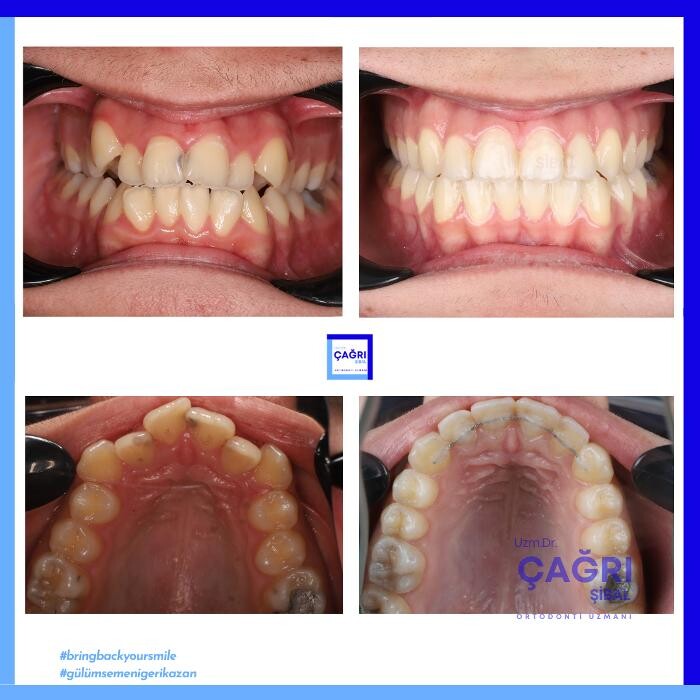 Images Ortodonti Uzmanı Çağrı Şibal - Ortodontik Tedavi I İzmir Şeffaf Plak I invisalign