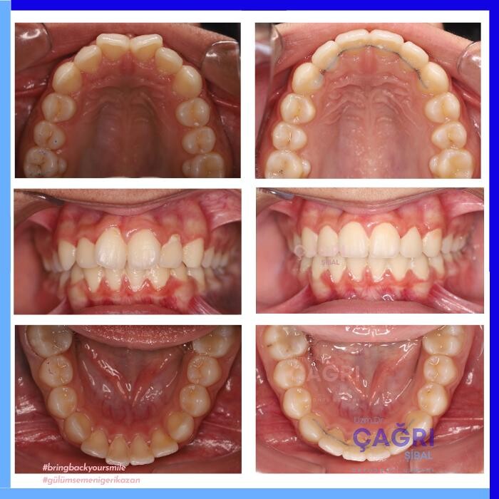 Images Ortodonti Uzmanı Çağrı Şibal - Ortodontik Tedavi I İzmir Şeffaf Plak I invisalign