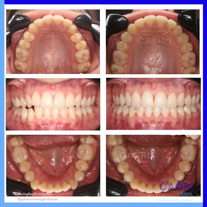 Images Ortodonti Uzmanı Çağrı Şibal - Ortodontik Tedavi I İzmir Şeffaf Plak I invisalign