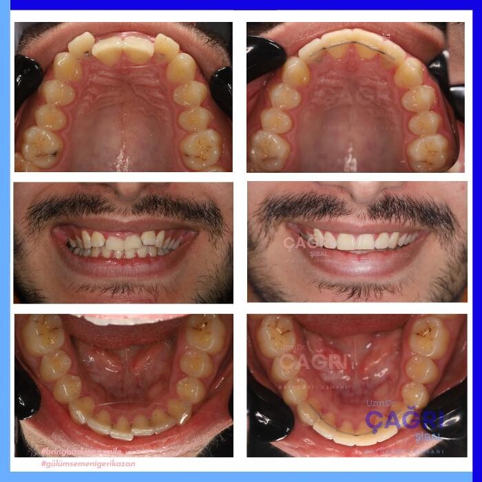 Images Ortodonti Uzmanı Çağrı Şibal - Ortodontik Tedavi I İzmir Şeffaf Plak I invisalign