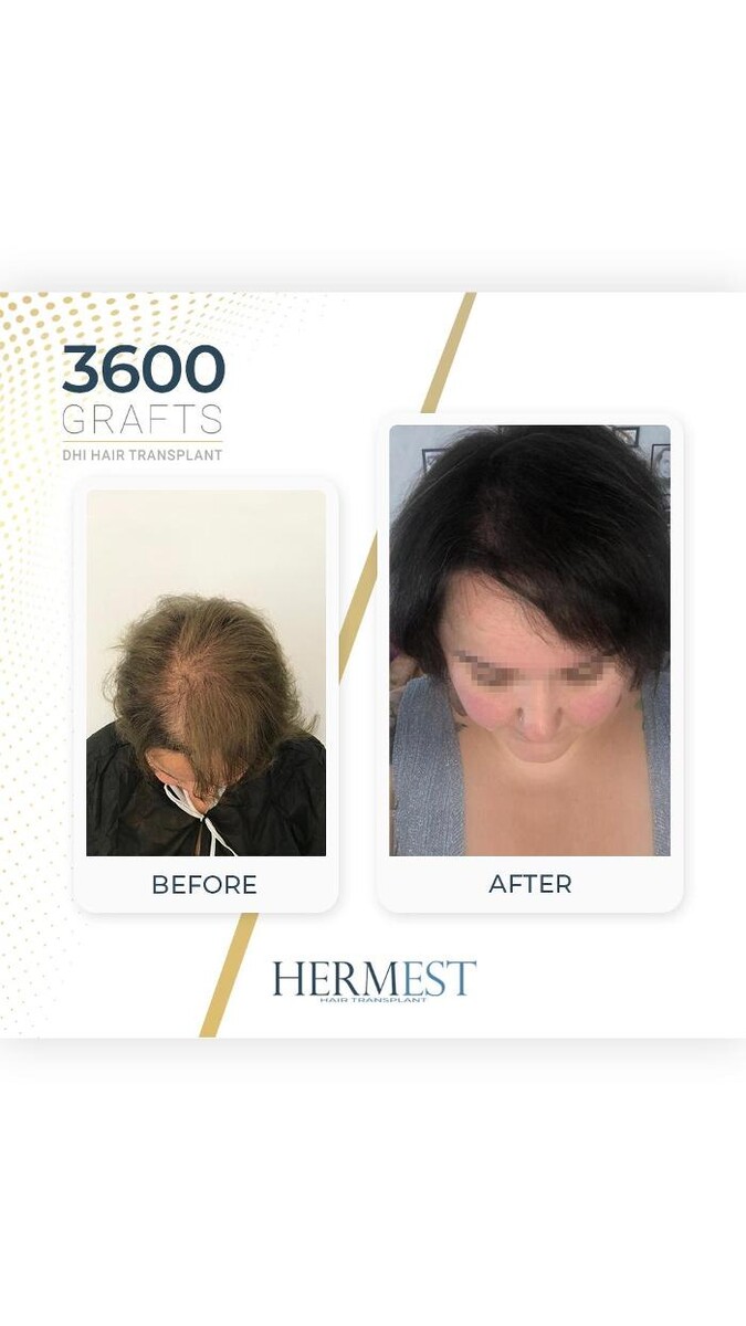 Images Hermest Hair Transplant Turkey