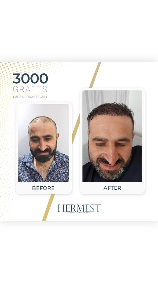 Images Hermest Hair Transplant Turkey