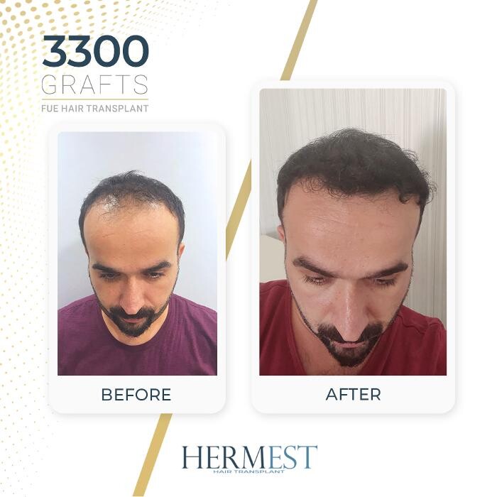 Images Hermest Hair Transplant Turkey