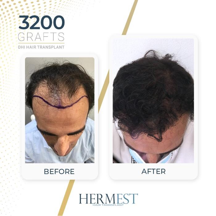Images Hermest Hair Transplant Turkey