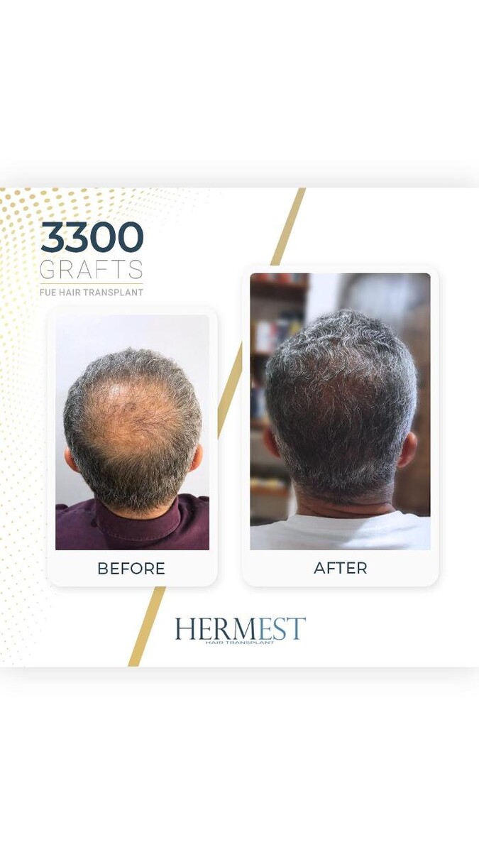 Images Hermest Hair Transplant Turkey