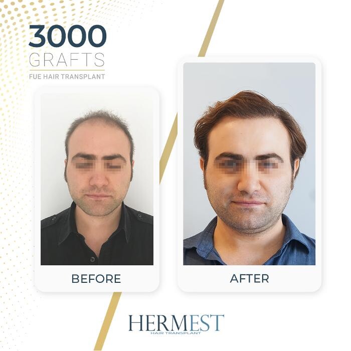 Images Hermest Hair Transplant Turkey