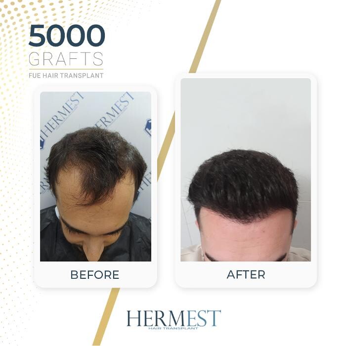 Images Hermest Hair Transplant Turkey