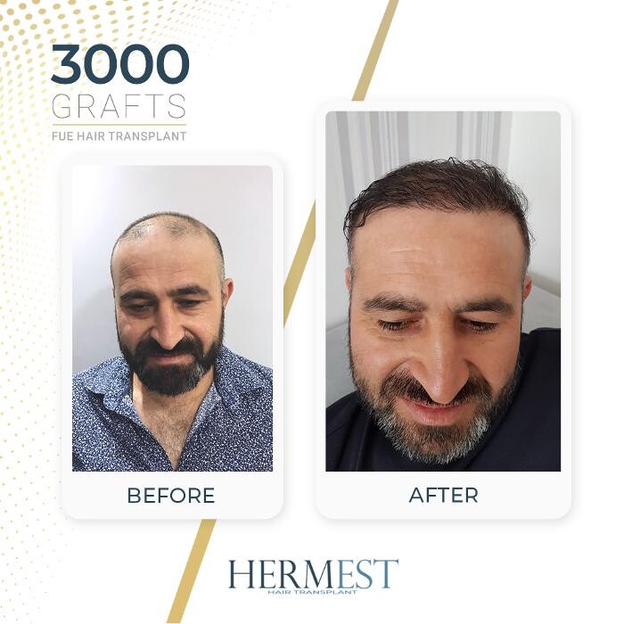 Images Hermest Hair Transplant Turkey