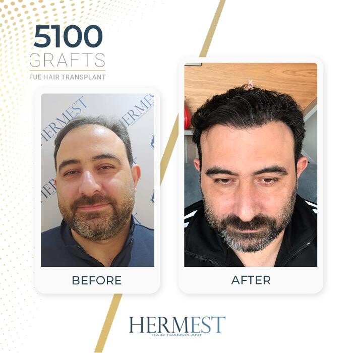 Images Hermest Hair Transplant Turkey