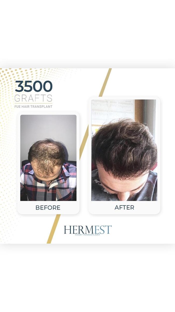 Images Hermest Hair Transplant Turkey