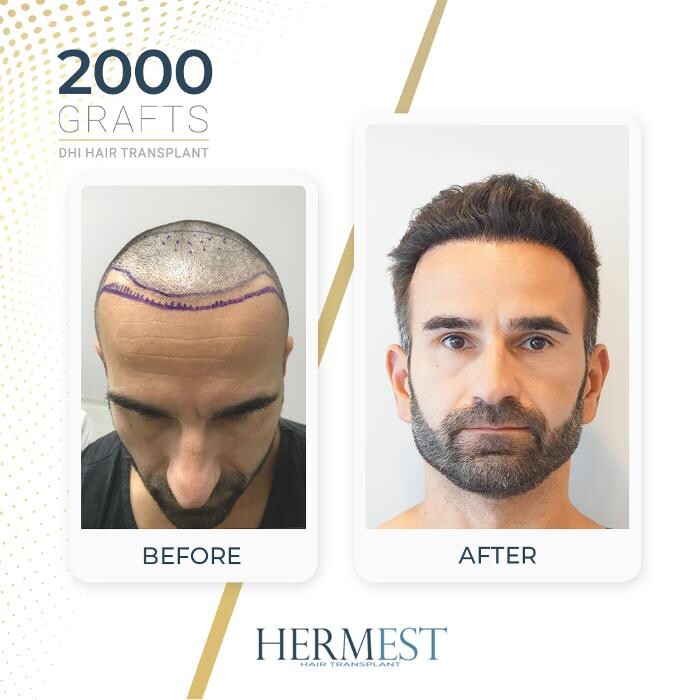 Images Hermest Hair Transplant Turkey