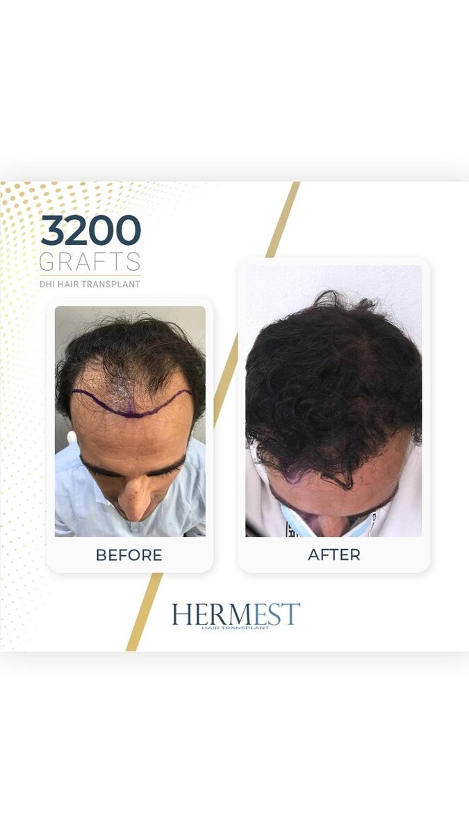 Images Hermest Hair Transplant Turkey