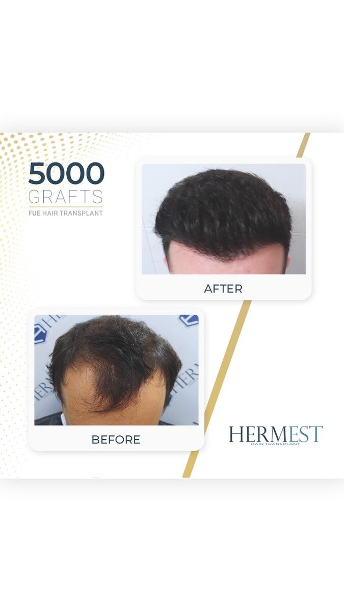Images Hermest Hair Transplant Turkey