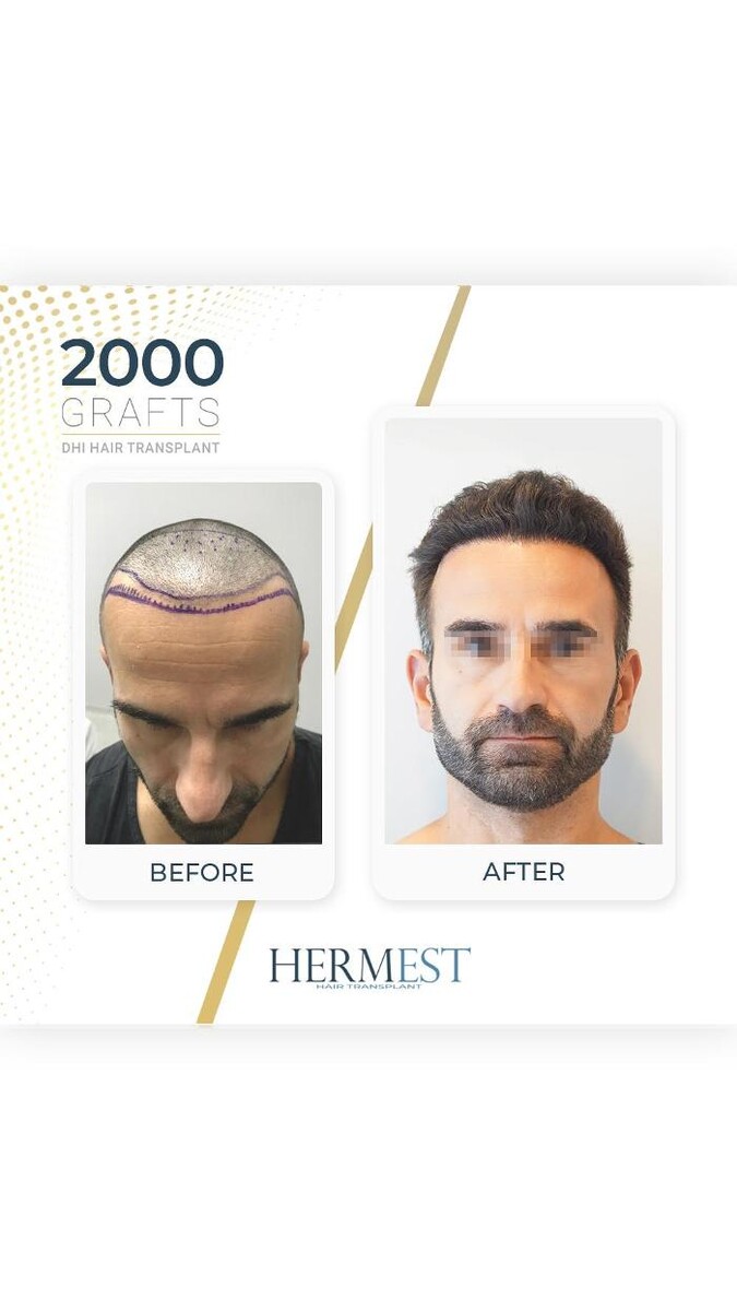 Images Hermest Hair Transplant Turkey