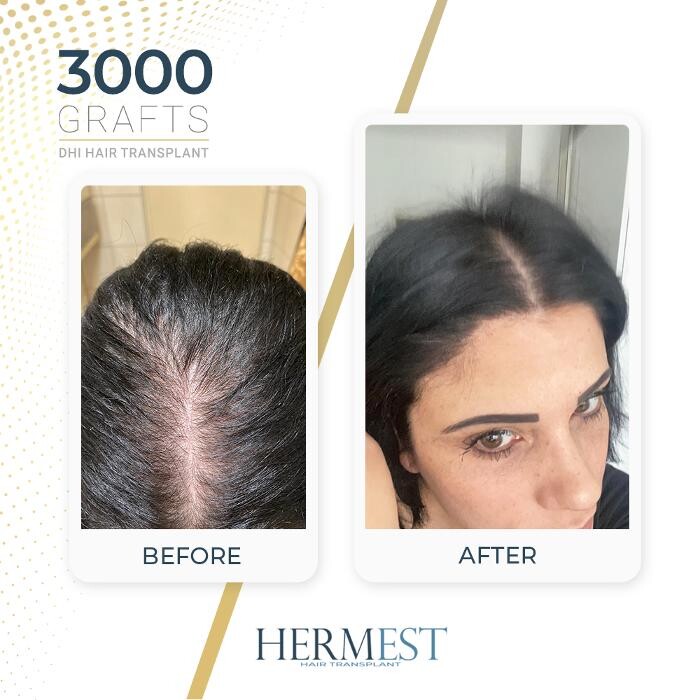 Images Hermest Hair Transplant Turkey