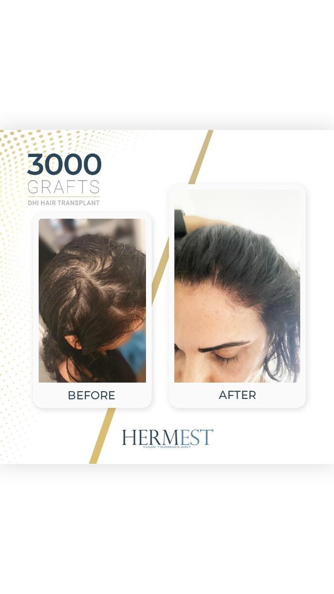 Images Hermest Hair Transplant Turkey